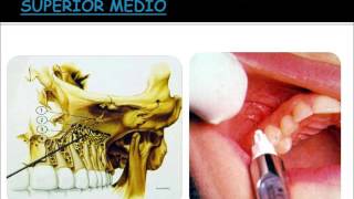 Anestésicos na Cirurgia BMF