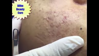 Acne clear - Blackhead removal - Beauty care video #21