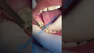 1st  molar Extraction