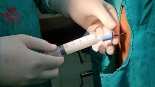 #LumbarEpidural_Injection #LumbarDiscProlapse #Sciatica #कमरदर्द #सियाटिका