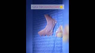 WDC - GIGI TIRUAN PATAH KEMBALI SEPERTI SEMULA | REMOVABLE DENTURE #shorts #dentist