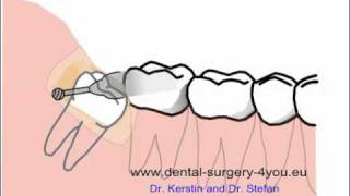 Odontectomie.flv