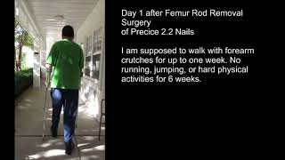 Femur Rod Removal - Day 1 (Precice 2.2 Nails and Syndesmotic Screws)