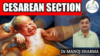 CESAREAN SECTION||#Gynecology