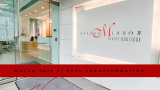 Watch This Whole VI Peel Transformation At Mirror Mirror Beauty Boutique!