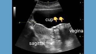 Menstrual cup, ultrasound and color Doppler imaging findings and appearances