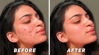 How to Remove Acne, Pimples in Adobe Photoshop | Paano Mag-alis ng Acne, Pimples sa Photoshop