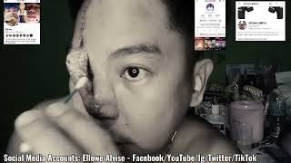 Ellowe Alviso | 7th Day Ng Paglilinis ko Ng Sugat Sa Aking Ilong | Skin Grafting forhead