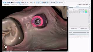 BSP V4.13: Design TiBase Crowns in Minutes with AI Automatic Tooth Design. Design and Export Free!