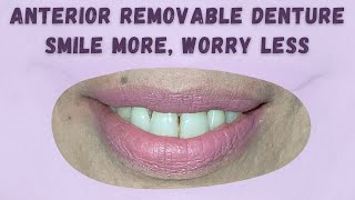 WDC_SENYUM PERCAYA DIRI DENGAN PEMAKAIAN GIGI TIRUAN | ANTERIOR REMOVABLE DENTURE