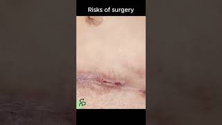 Risks of surgery #pregnancy #baby #shorts