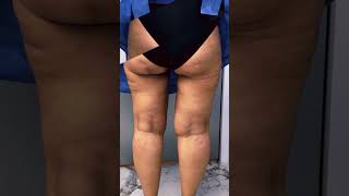 Op. Dr. Onur Gökdemir GCC Gökdemir Clinic Leg Lift Leg Liposuction Bacak Lipo