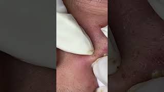 Big Cystic Acne Blackheads Extraction Blackheads & Milia, Whiteheads Removal Pimple Popping #shorts