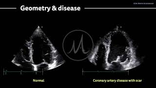 〖Echocardiography〗 Coronary artery disease & the left ventricle ❤️‍🩹