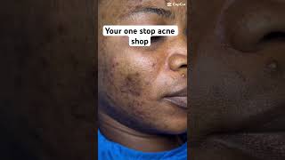 Our acne workshop is open #skin #acne #skincaretips #skincare