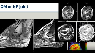 Emory MSK E-Lecture Series - Dr. Avneesh Chhabra.