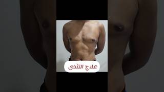 Gynecomastia surgery علاج التثدى د محمد الهيتمى