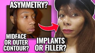 What I wish I knew before I got cheek implants | Opt into Beauty