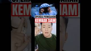 Operasi kembar siam #kembar #operasi