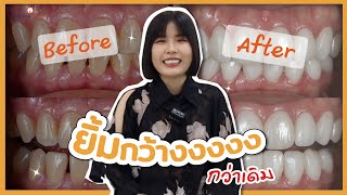 เปลี่ยนฟันเหลือง เป็นฟันสวยแบบถาวร | รีวิวคนไข้วีเนียร์ เคสคุณหมอณัฐนรี Dentalimage