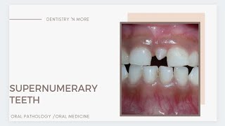 SUPERNUMERARY TEETH