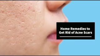 How to remove Acne scars by natural remedies | How to remove the acne scars | Home Remedies for Acne