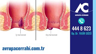 Hemoroid (Basur) Nedir? Avrupa Cerrahi