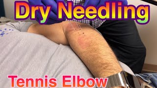 Dry needling painful elbow