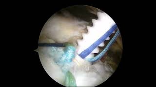 biceps rerouting 6 - supraspinatus tendon repair