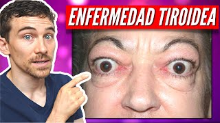 7 signos de enfermedad ocular tiroidea y enfermedad de Graves