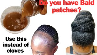 Use This If You Have Bald Patches, Receding Hairline and Thinning Hair. How to Regrow Bald spots