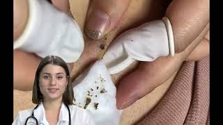 Dr.Natacha, blackheads removal, satisfying, ASMR.