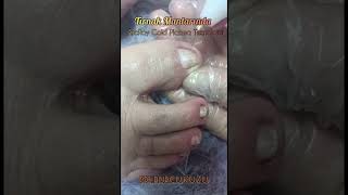 Toenail Fungus Treatment with Cold Plazma | Cold Plazma ile Tırnak Mantarı Bakımı