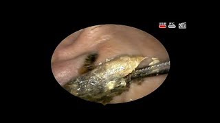 #Earwax removal Удаление #серной пробки #ЛОР КЛИНИКА ОБРАЗЦОВА