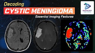 Decoding Cystic Meningioma | Dr. Umamaheswara Reddy .V