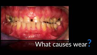 What Causes Severe Wear | Full Mouth Rehabilitation - Dr. Dennis Hartlieb