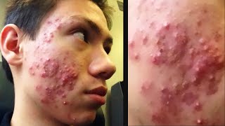 Comedonal Acne! Worst Cystic Acne Ever!