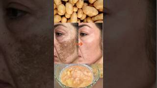 Potato to remove pigmentation, dark spots, acne scars #ashortaday #potatofacemask #trending