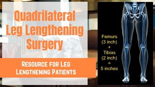 Quadrilateral Leg Lengthening Surgery (both Femurs and Tibias)