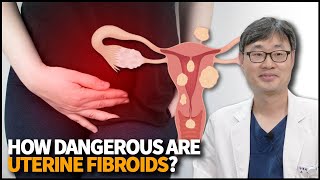 What are Uterine Fibroids? How dangerous are Uterine Fibroids? How can we treat and prevent it?