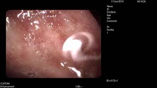 Diverticulosis of colon