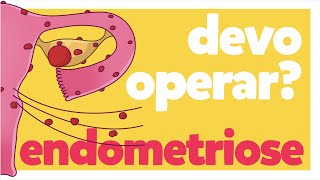 Quando devo operar endometriose? | Cirurgia de Endometriose