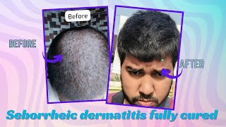 Overcoming Seborrheic Dermatitis & Anxiety Mood disorder to confident person | Transformation Story"