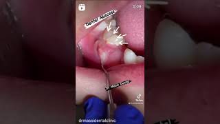 Dental Abscess