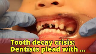 Tooth decay crisis: Dentists plead with parents to reduce children's sugar intake