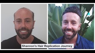 Shannon's Shares His Hair Piece Journey