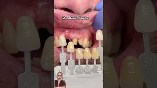 Front teeth crown #dentalcare #dental