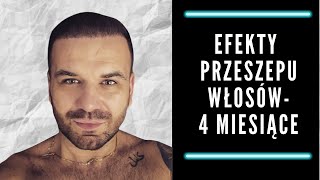 Efekty przeszczepu włosów - 4 miesiące.