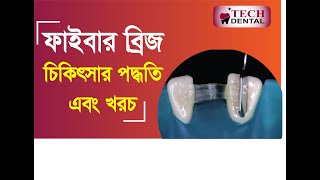 ১ দিনে নতুন দাঁত লাগানোর চিকিৎসার খরচ (ফাইবার ব্রিজ)। Dental Fibre Bridge Cost in BD।  Tech Dental