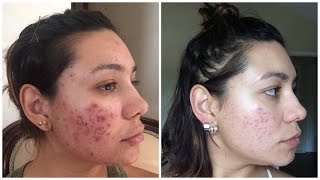 Como Curar el Acne Para Siempre!!!